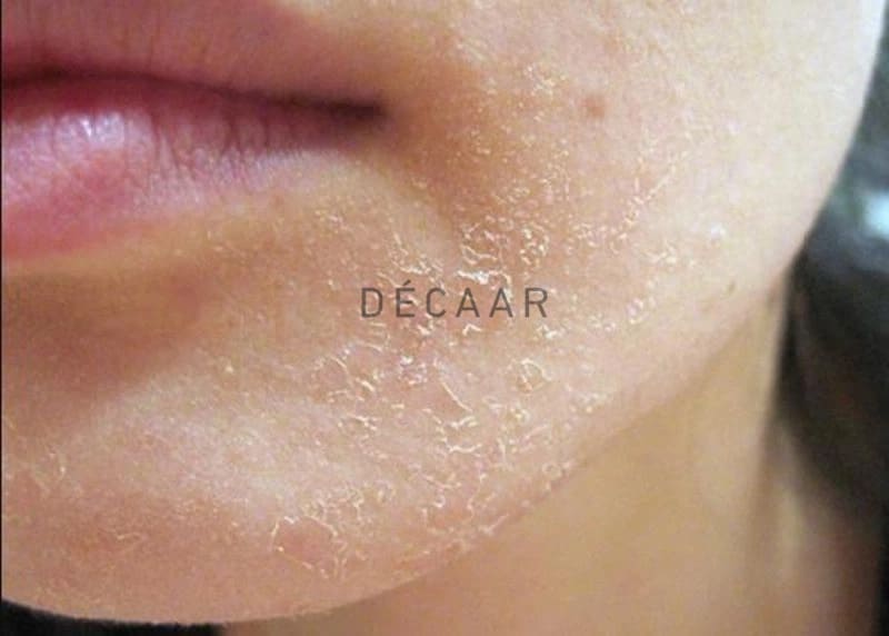 da bị sần sùi cần detox